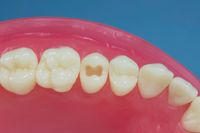 Dente Para Manequim De Dentística 15