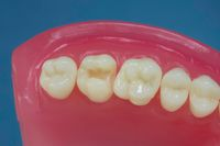 Dente Para Manequim De Dentística 17