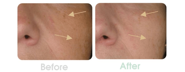 before after dark spots with skinax