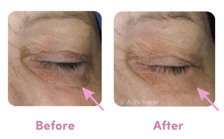 before after dark circles with skinax