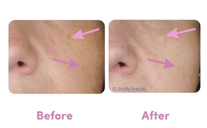 before after dark spots with skinax