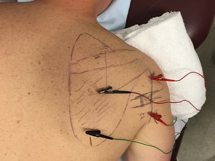 Why Does Adding Electricity to Dry Needling Make It More Effective? -  Western Slope Rehab & Performance