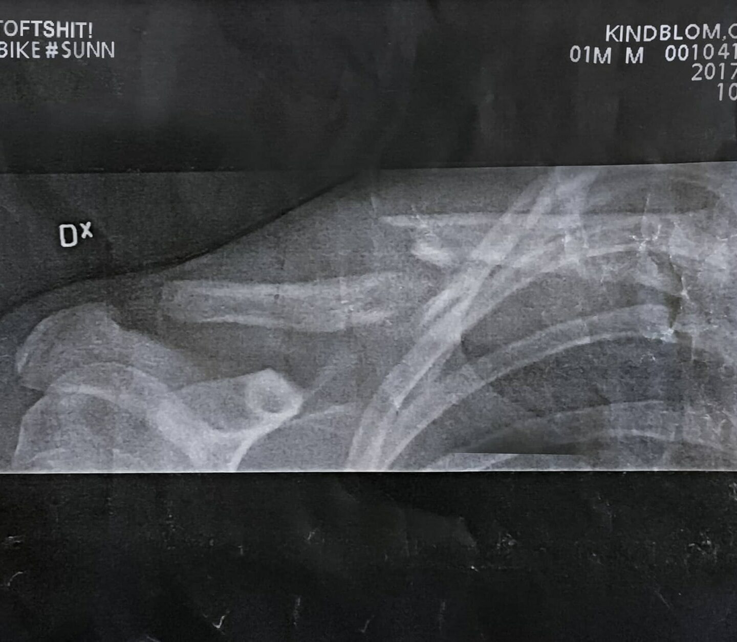 Oskar crashed hard during practice