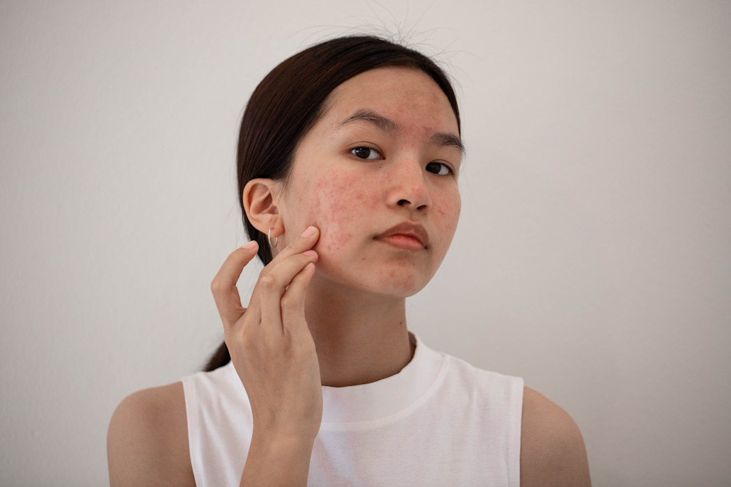 Acne treatment