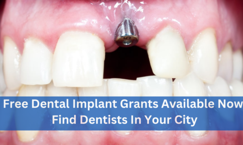 Free Dental Implants Now Available – See How to Get Yours