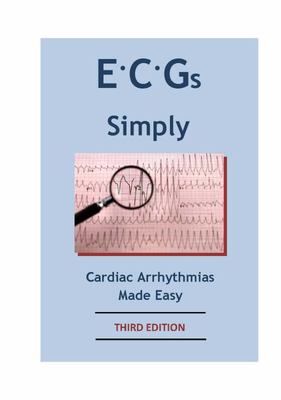 Ecgs Simply Cardiac Arrhythmias Made Easy