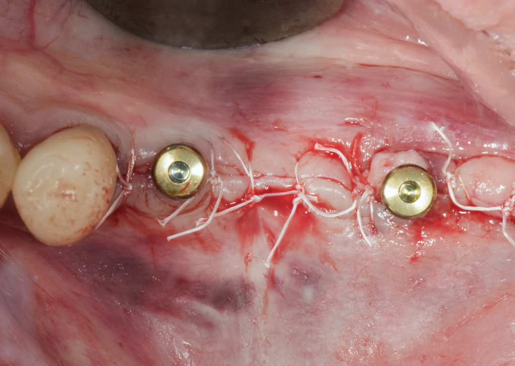 Do gums grow back after implants?