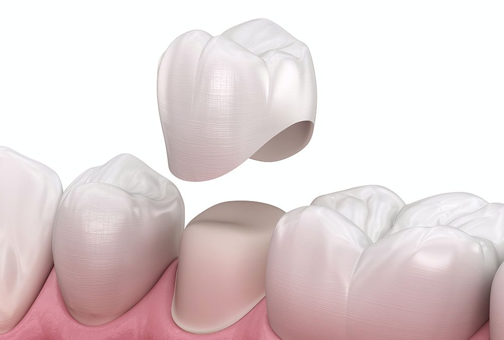 How to care for dental crowns?