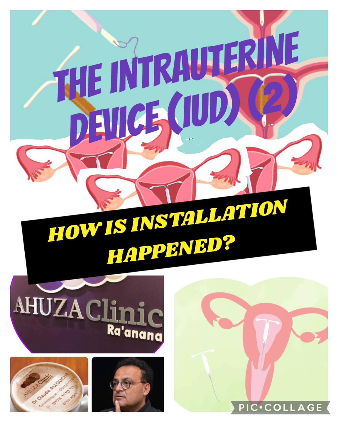 THE IUD (IUD 2): HOW IS INSTALLATION HAPPENED?