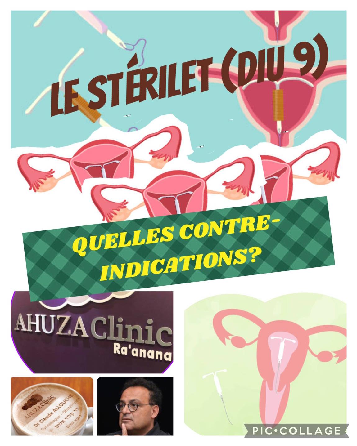 LE STERILET (DIU 9) :