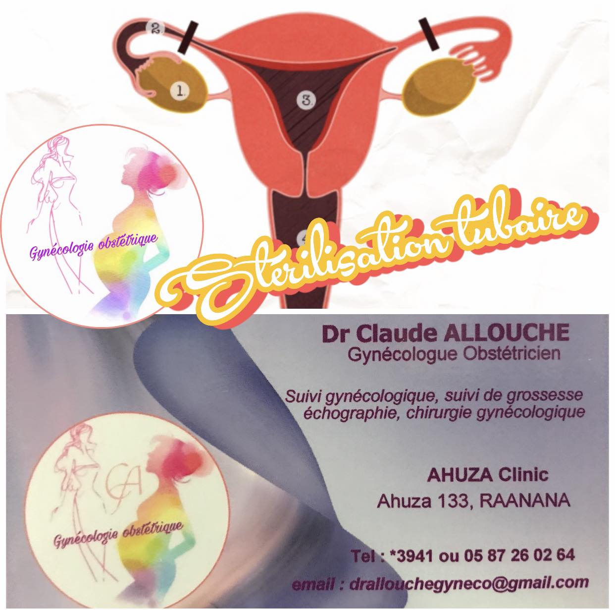 CONTRACEPTION DEFINITIVE