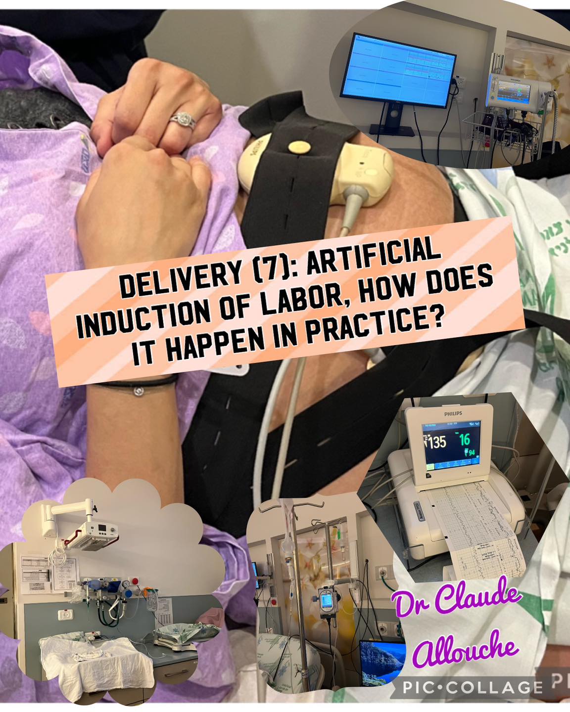 DELIVERY (7): ARTIFICIAL INDUCTION OF LABOR, HOW DOES IT HAPPEN IN PRACTICE?