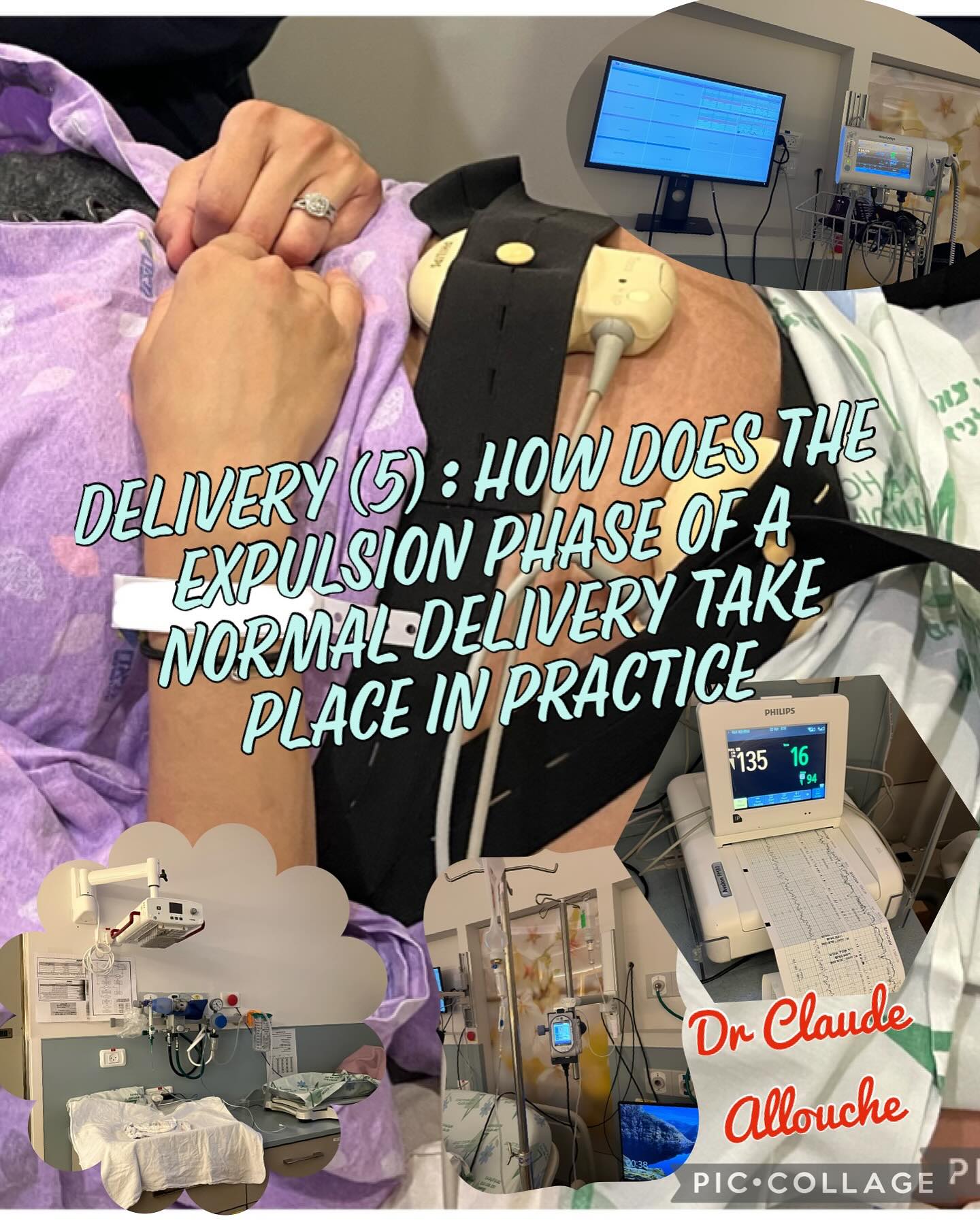 DELIVERY (5): HOW DOES THE EXPULSION PHASE OF A NORMAL DELIVERY TAKE PLACE IN PRACTICE