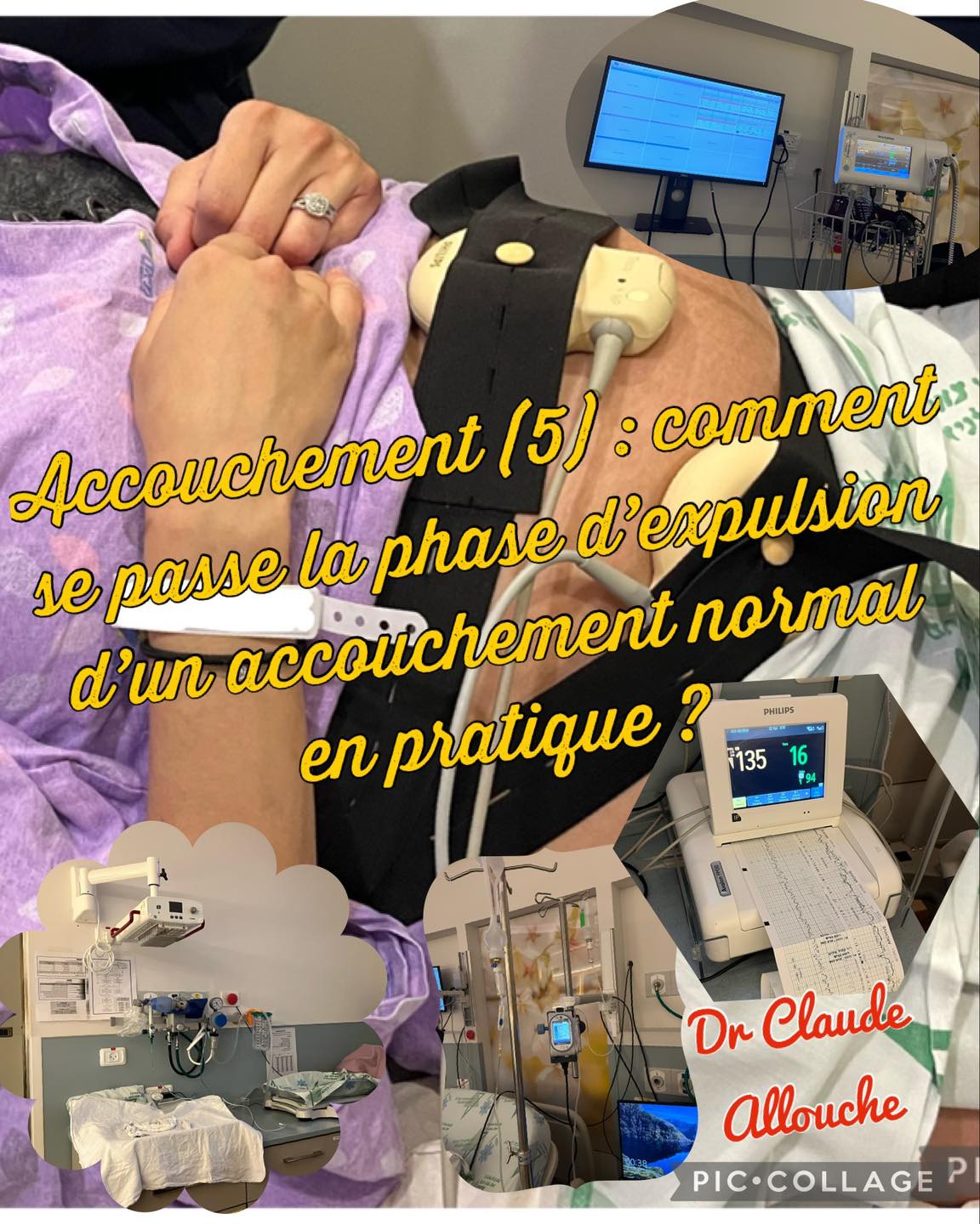 ACCOUCHEMENT (5) : COMMENT SE PASSE LA PHASE D&rsquo;EXPULSION D&rsquo;UN ACCOUCHEMENT NORMAL EN PRATIQUE?