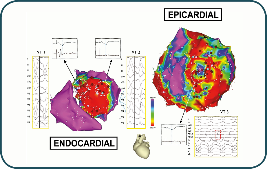Epicardium Vs Endocardium logo
