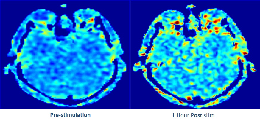ASL MRI Pre and Post Stimulation  logo