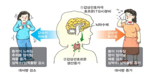 갑상선 기능 저하증