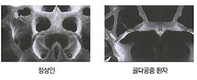 골다공증