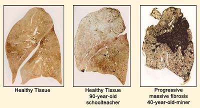 Image of the effects of Black lung