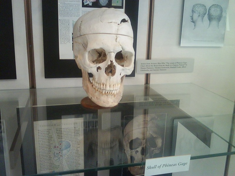 This is an up-close view of Gage's skull at Harvard University School of Medicine.