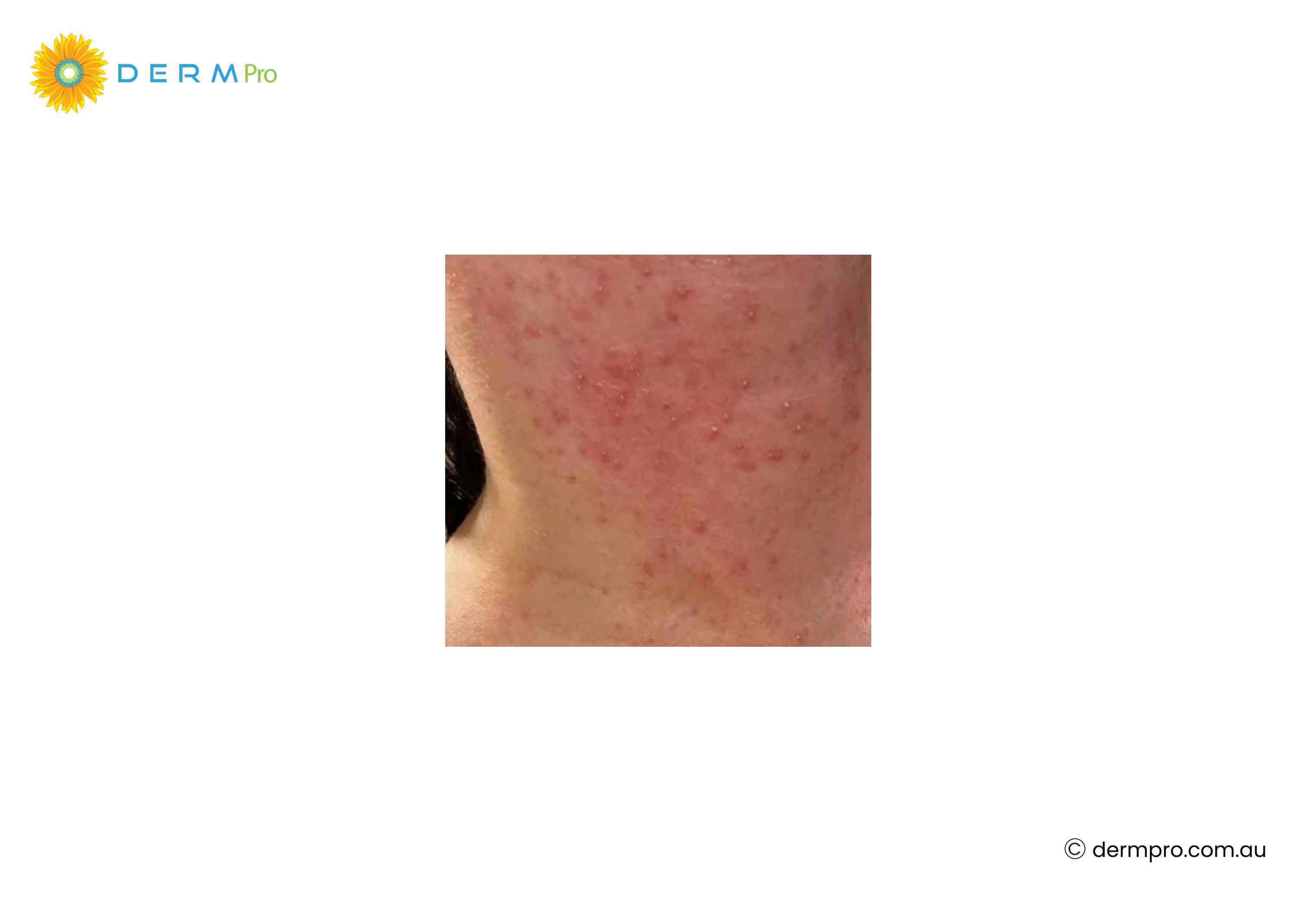 Heat Rash