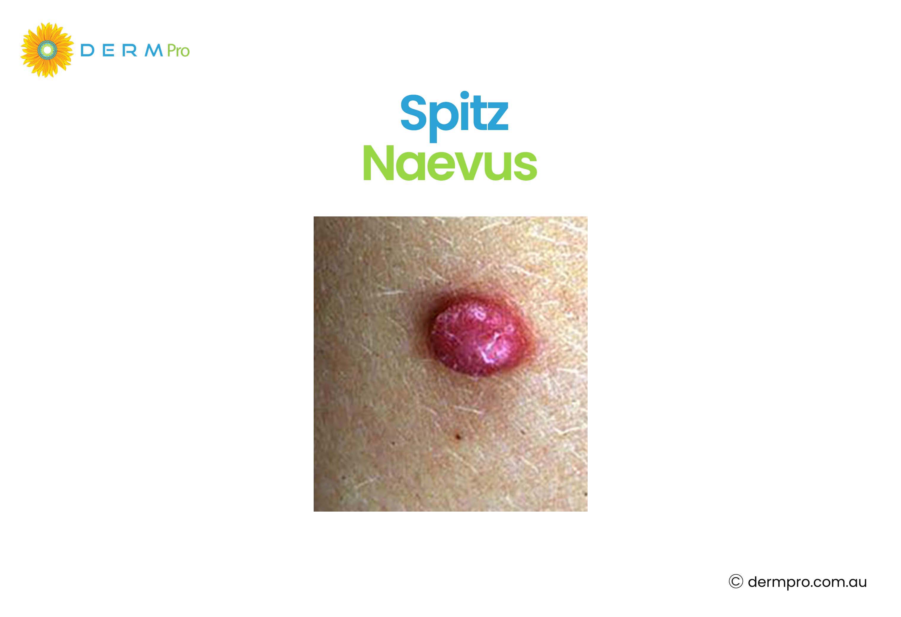 spitz naevus 
