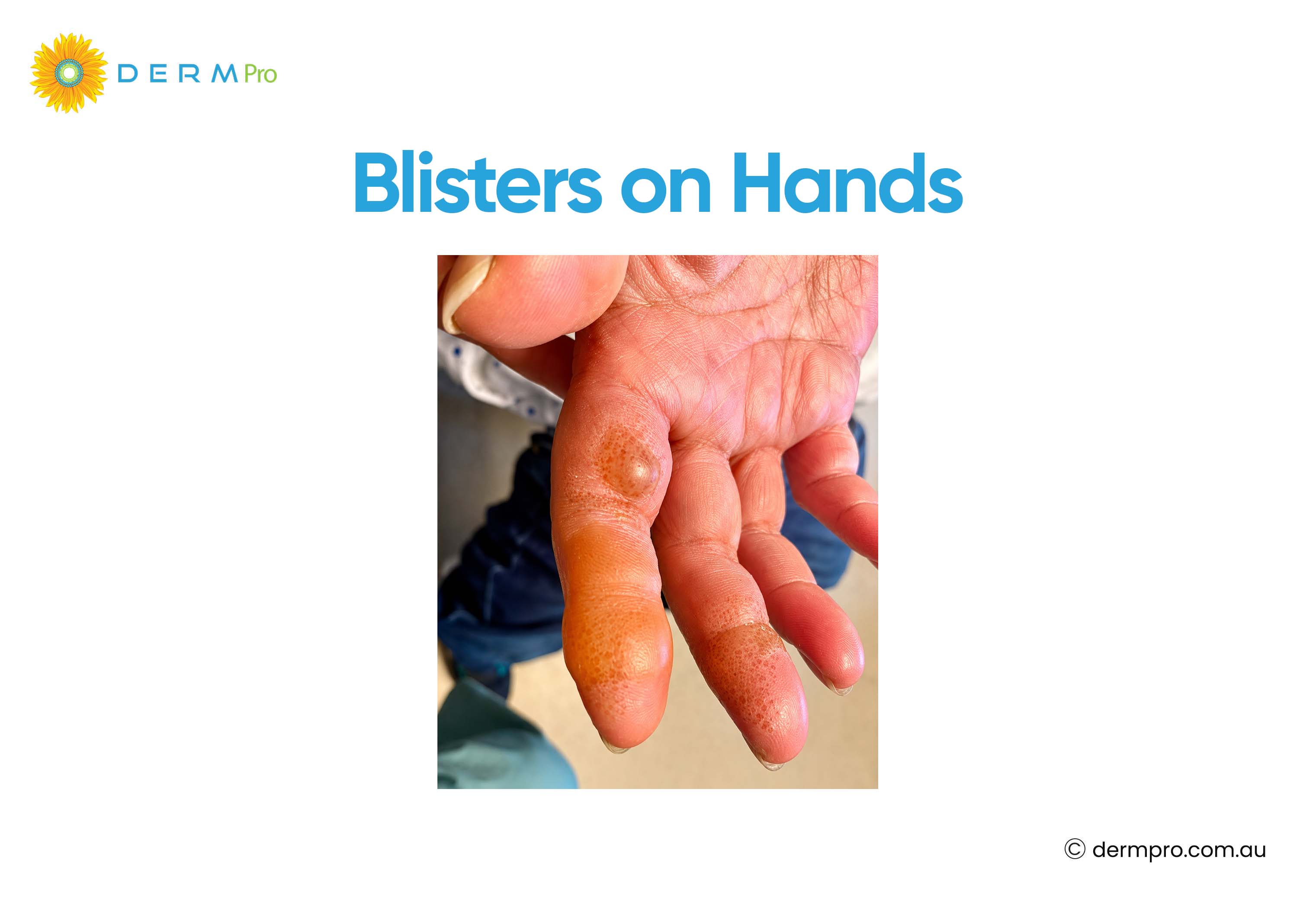 Blisters on Hands