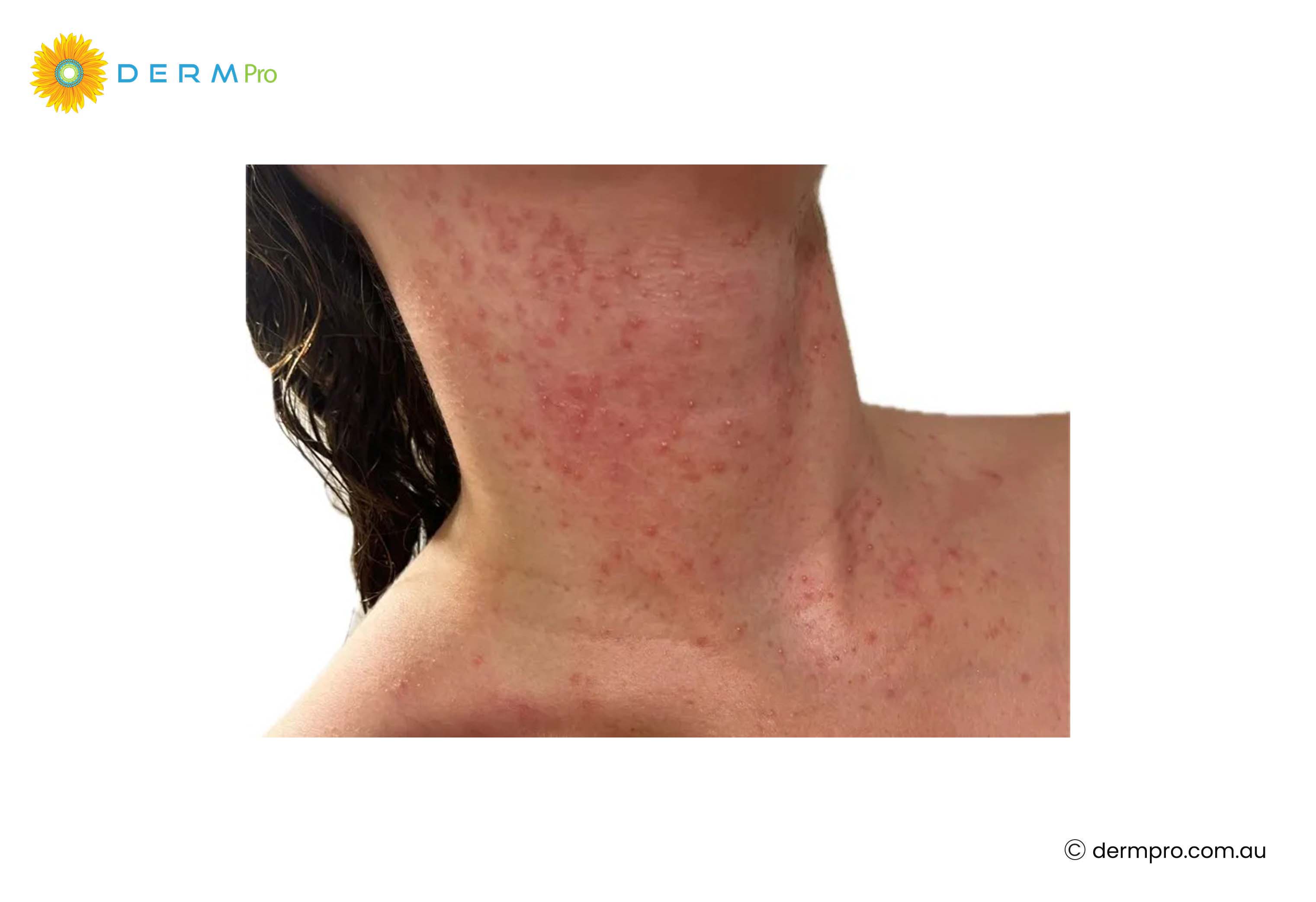 Heat Rash 