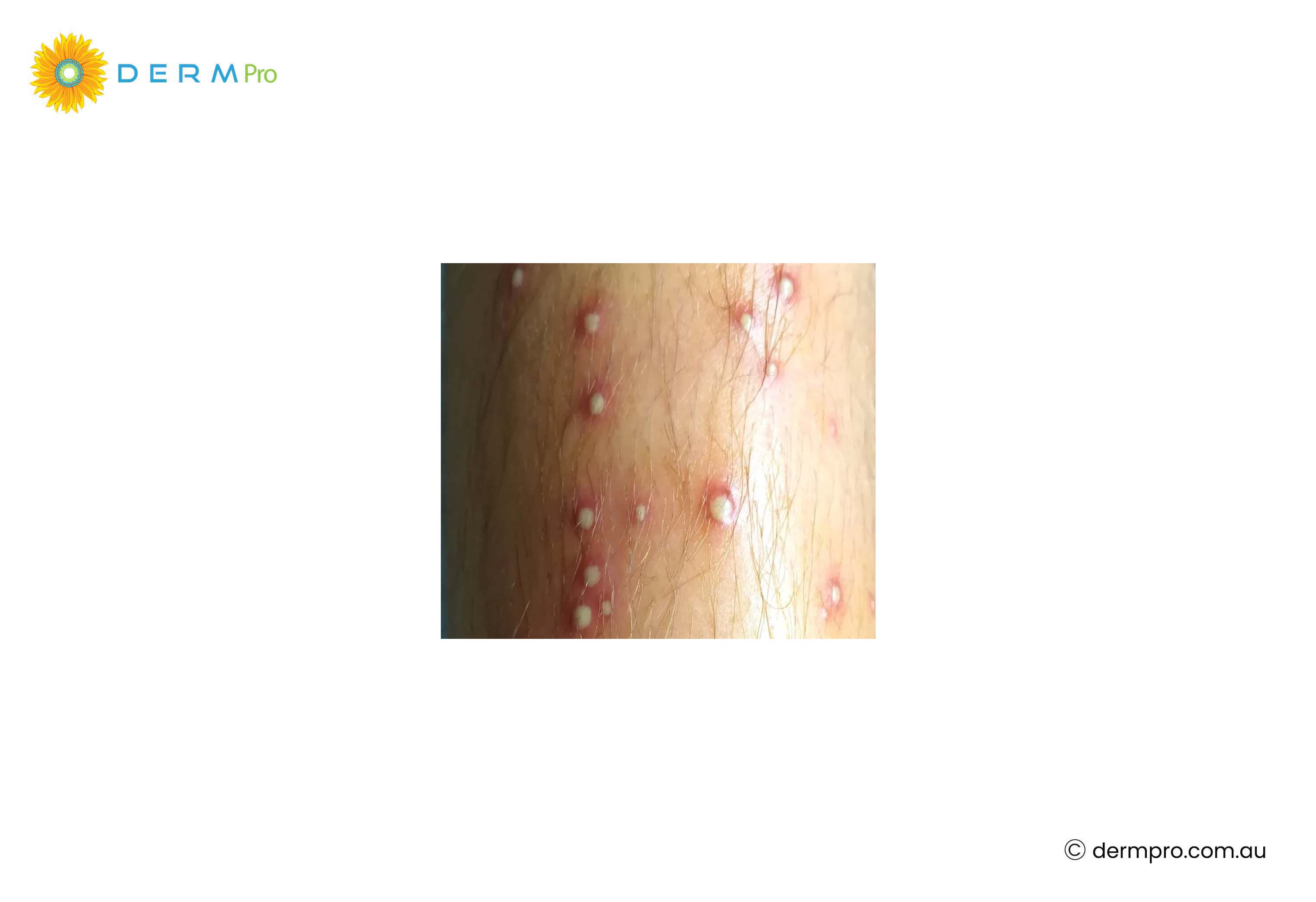 Folliculitis