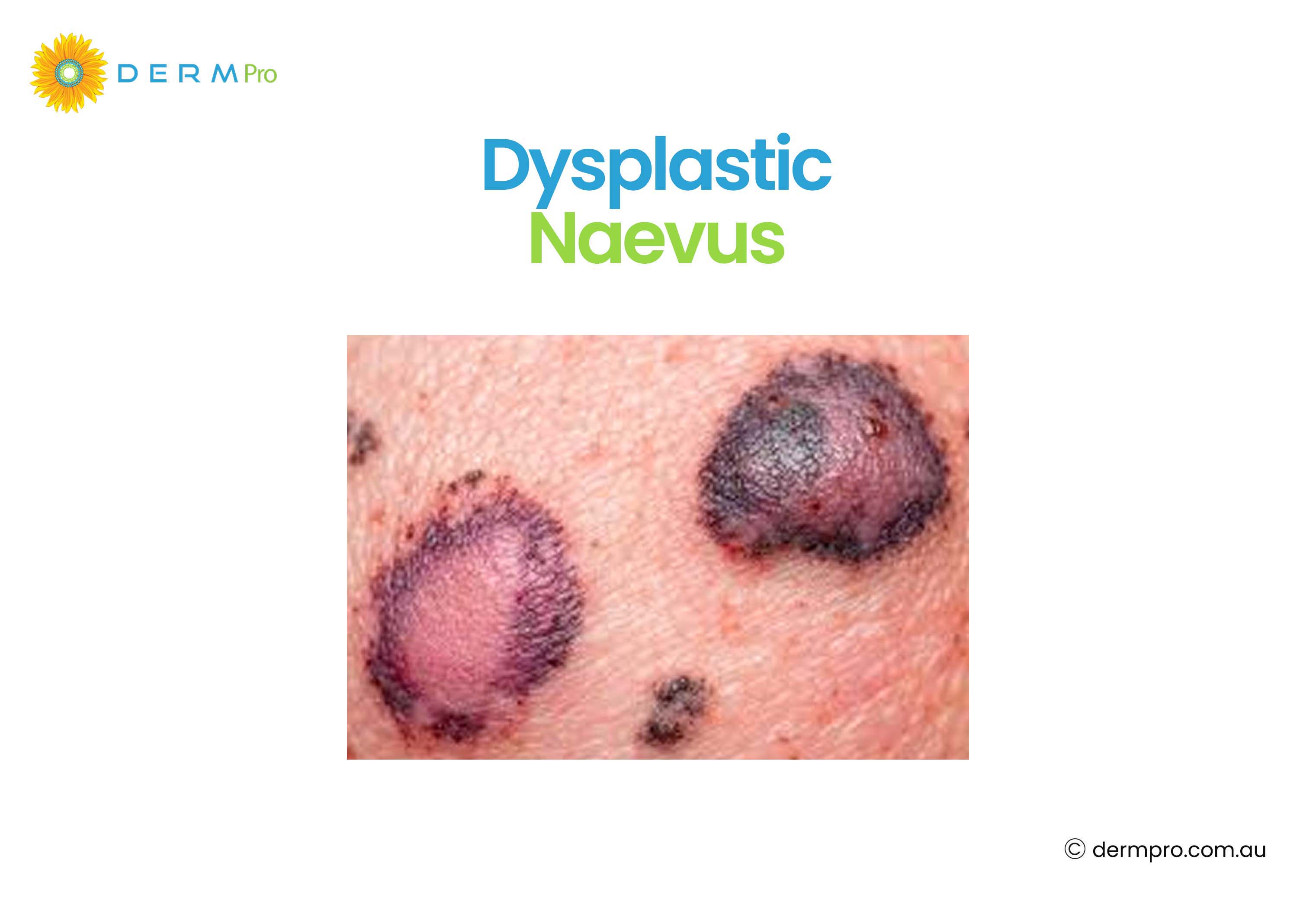 Dysplastic Naevus 