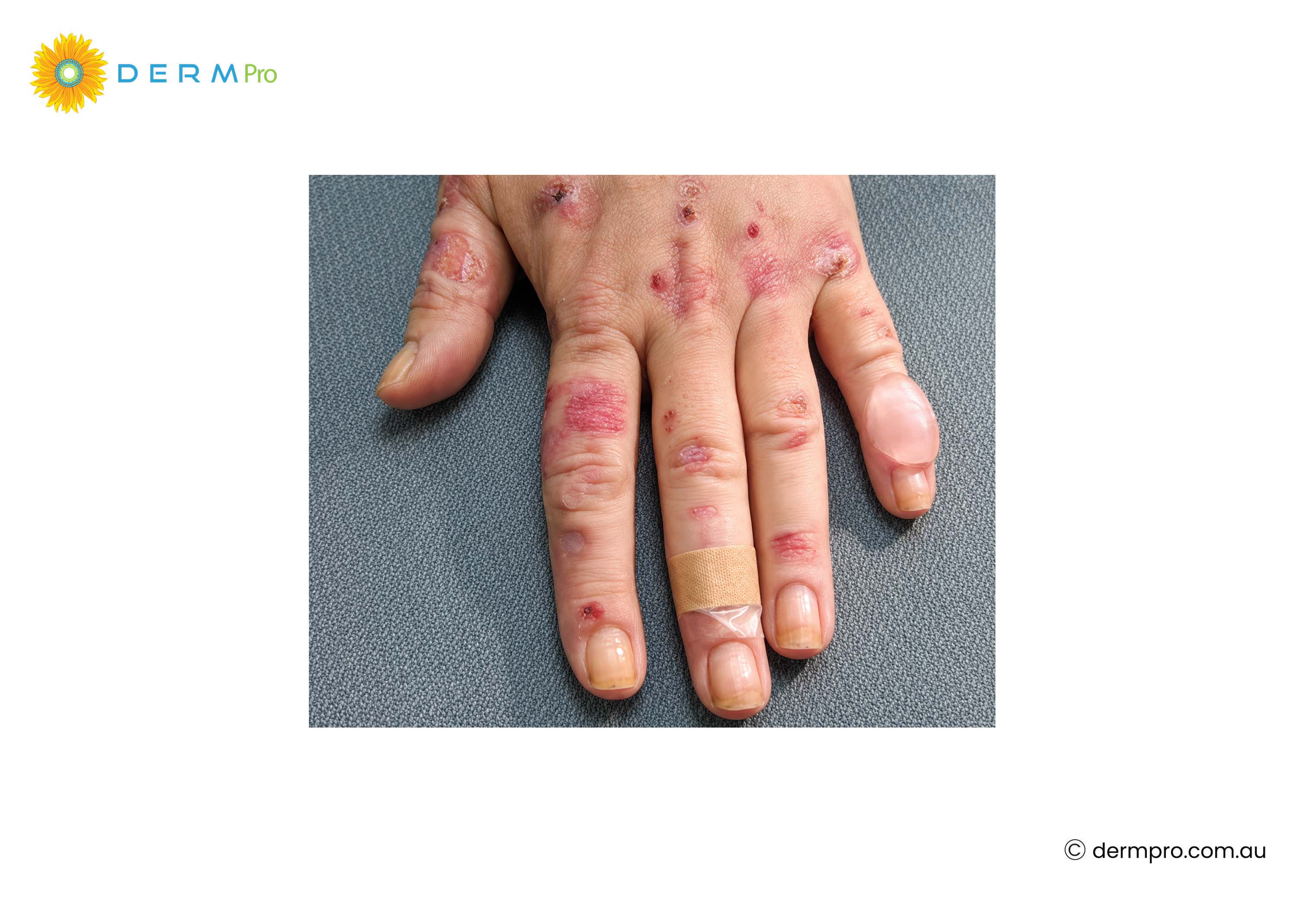 blisters on hands 