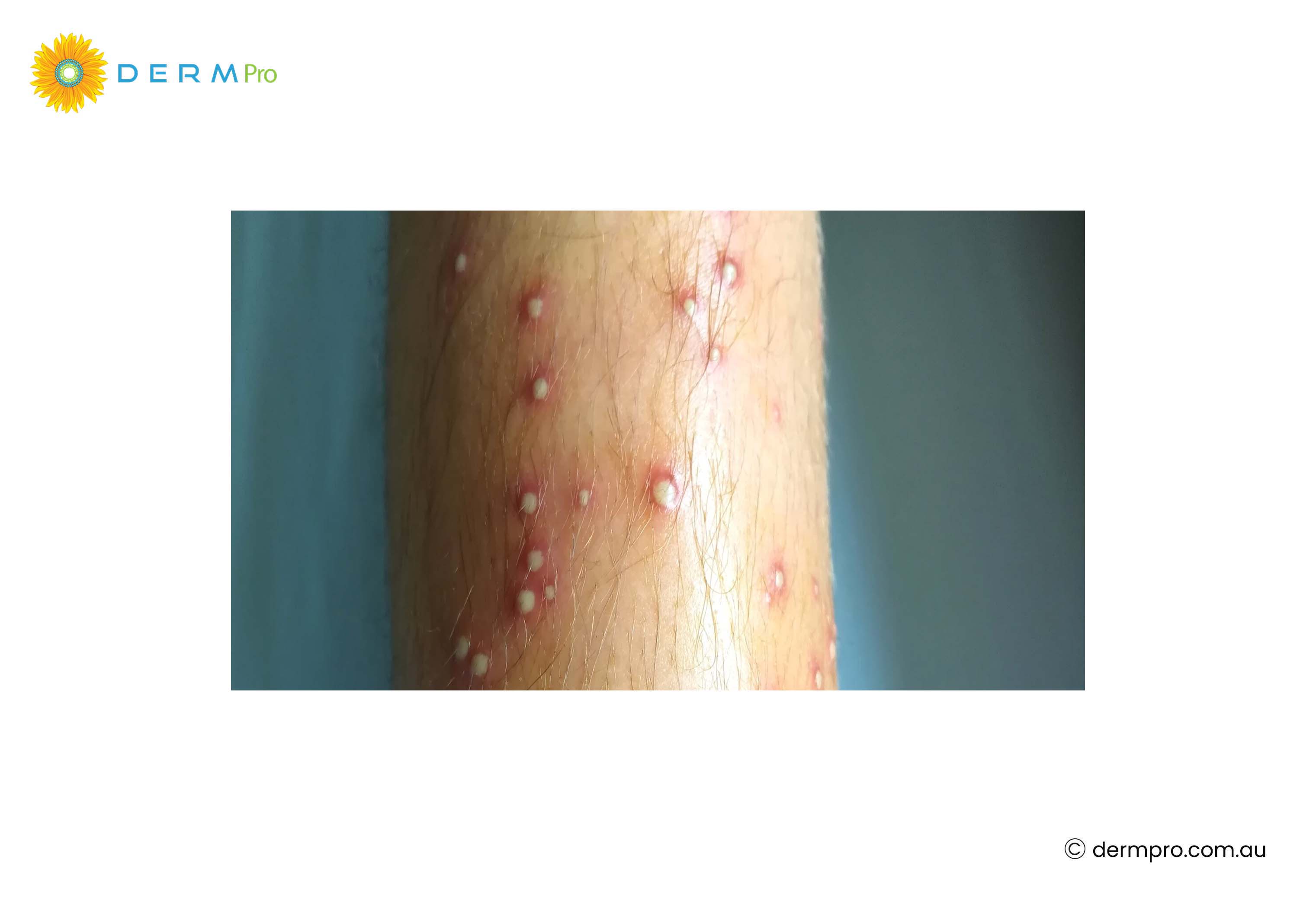 Folliculitis 