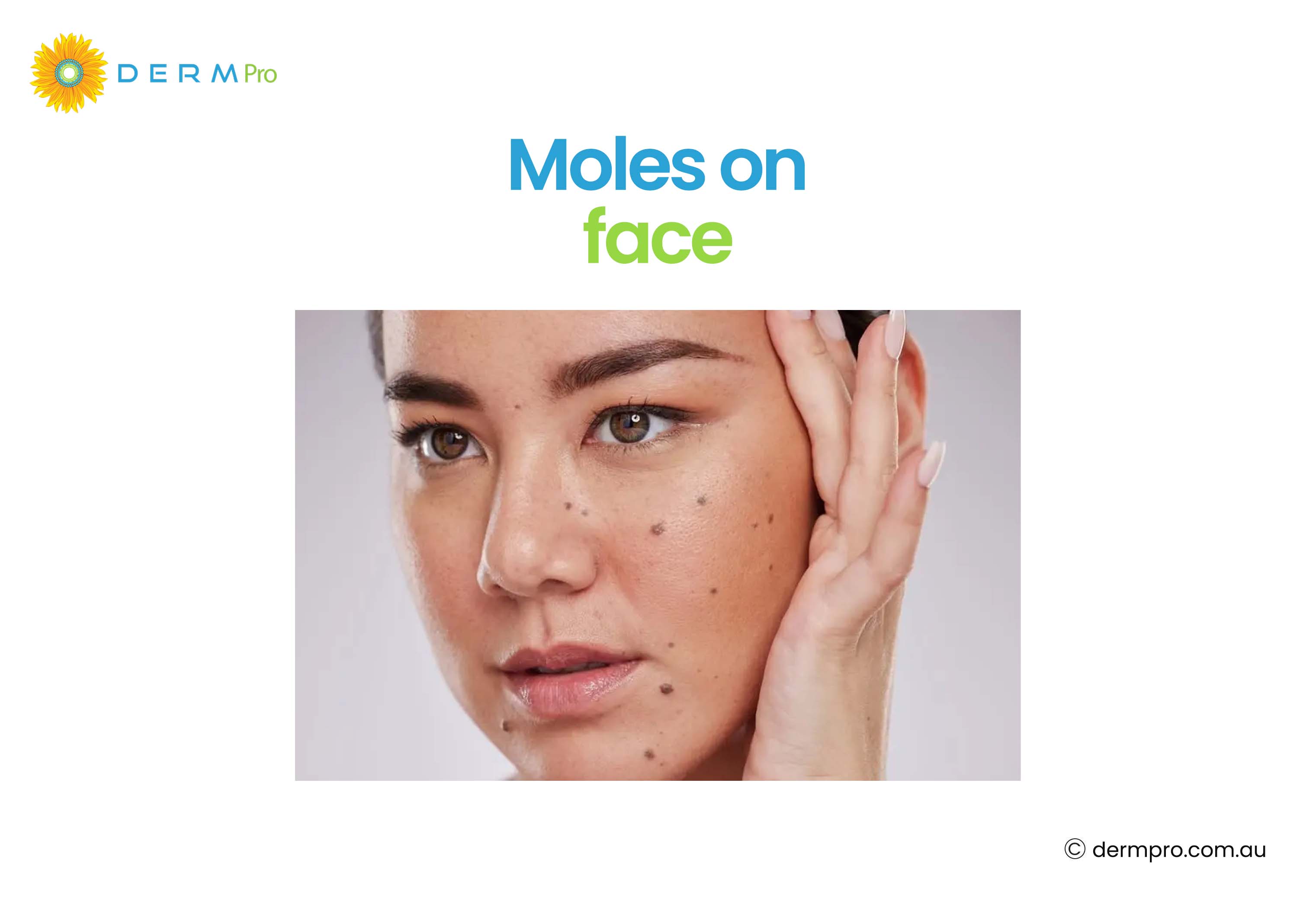 Moles on Face