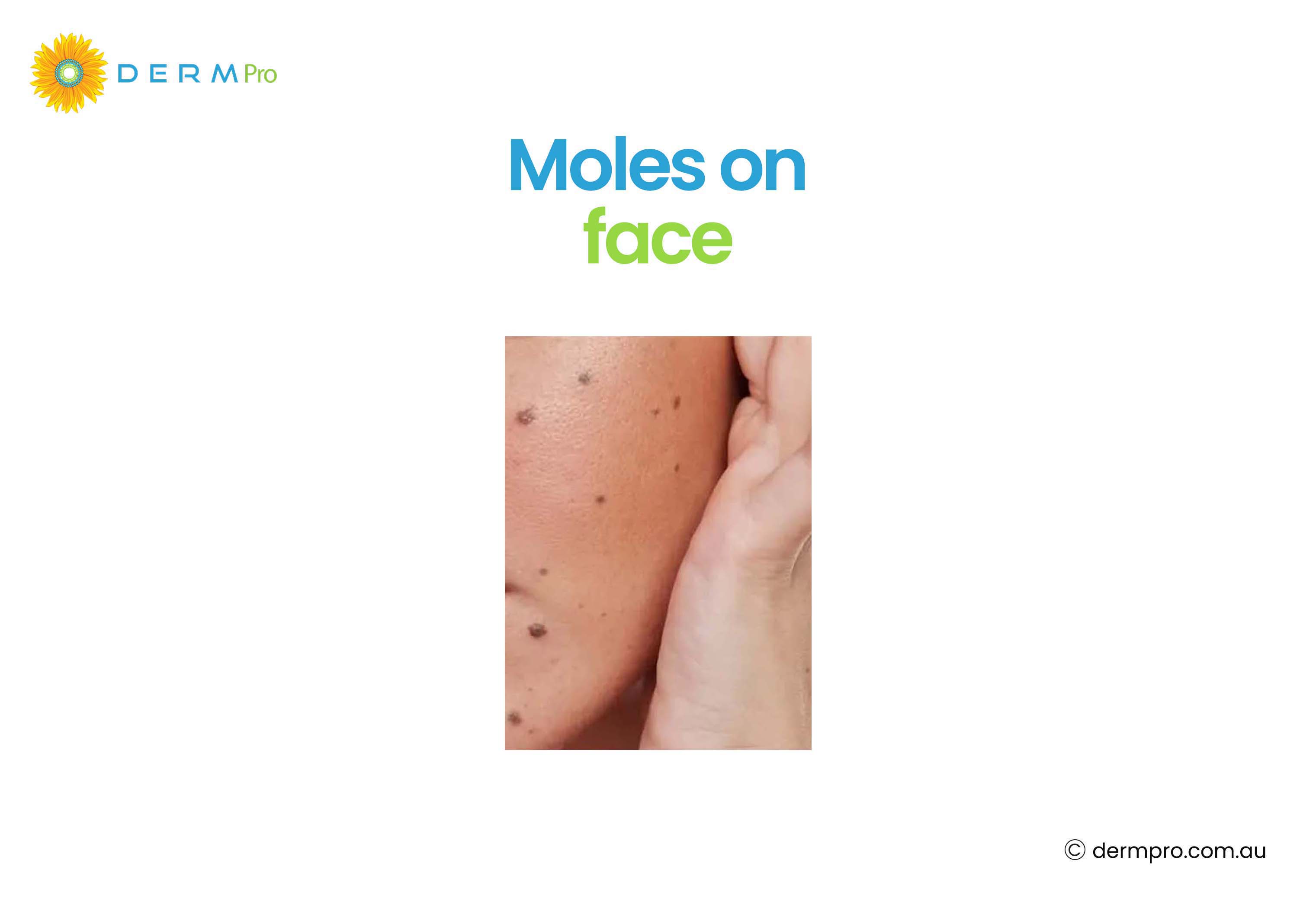 moles on face 