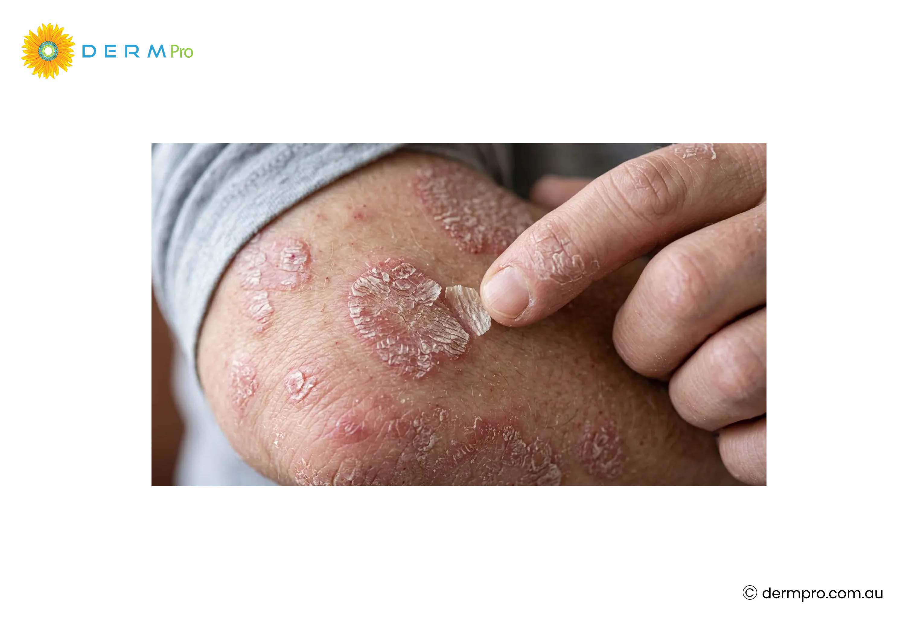 Psoriasis 