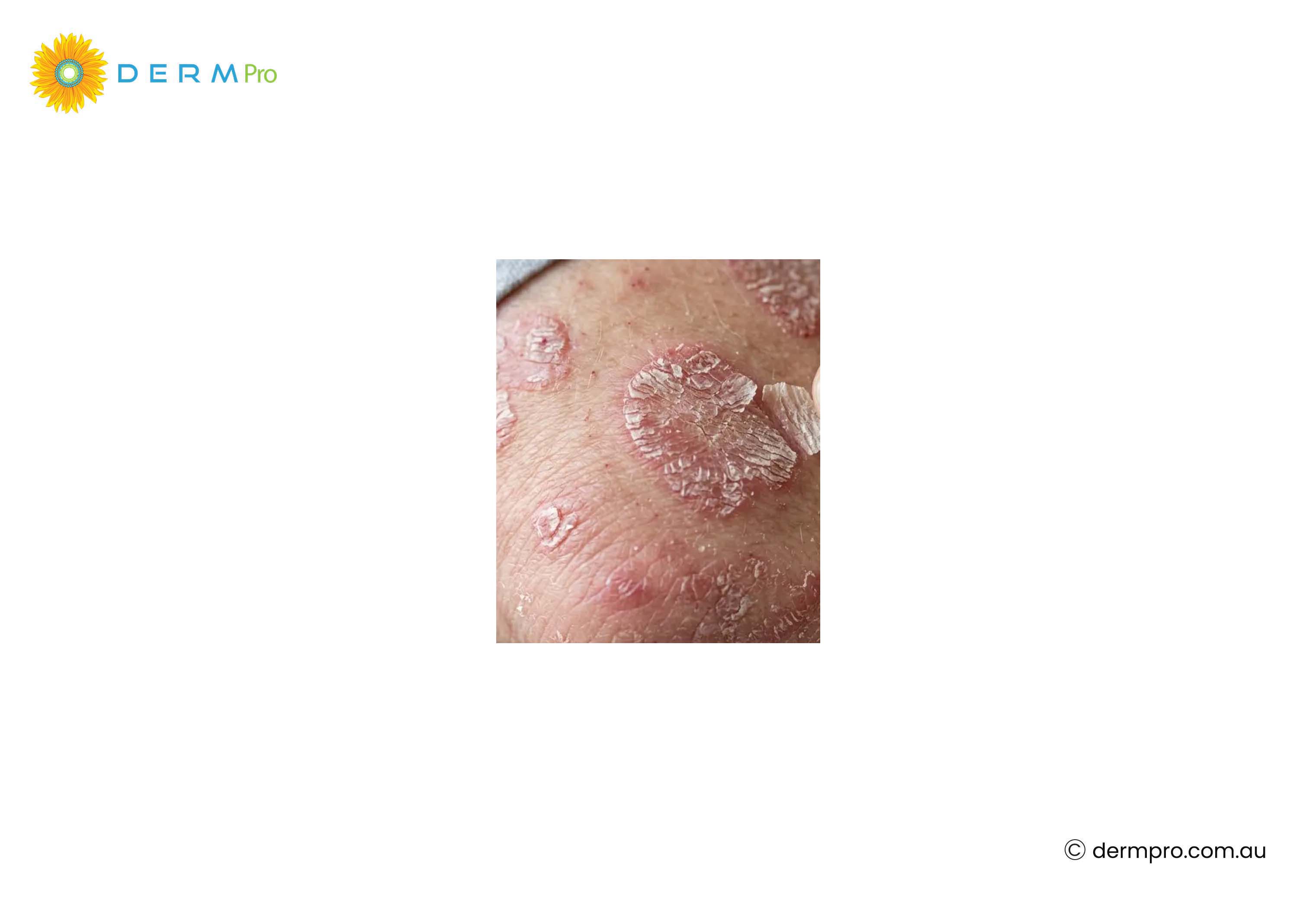 Psoriasis