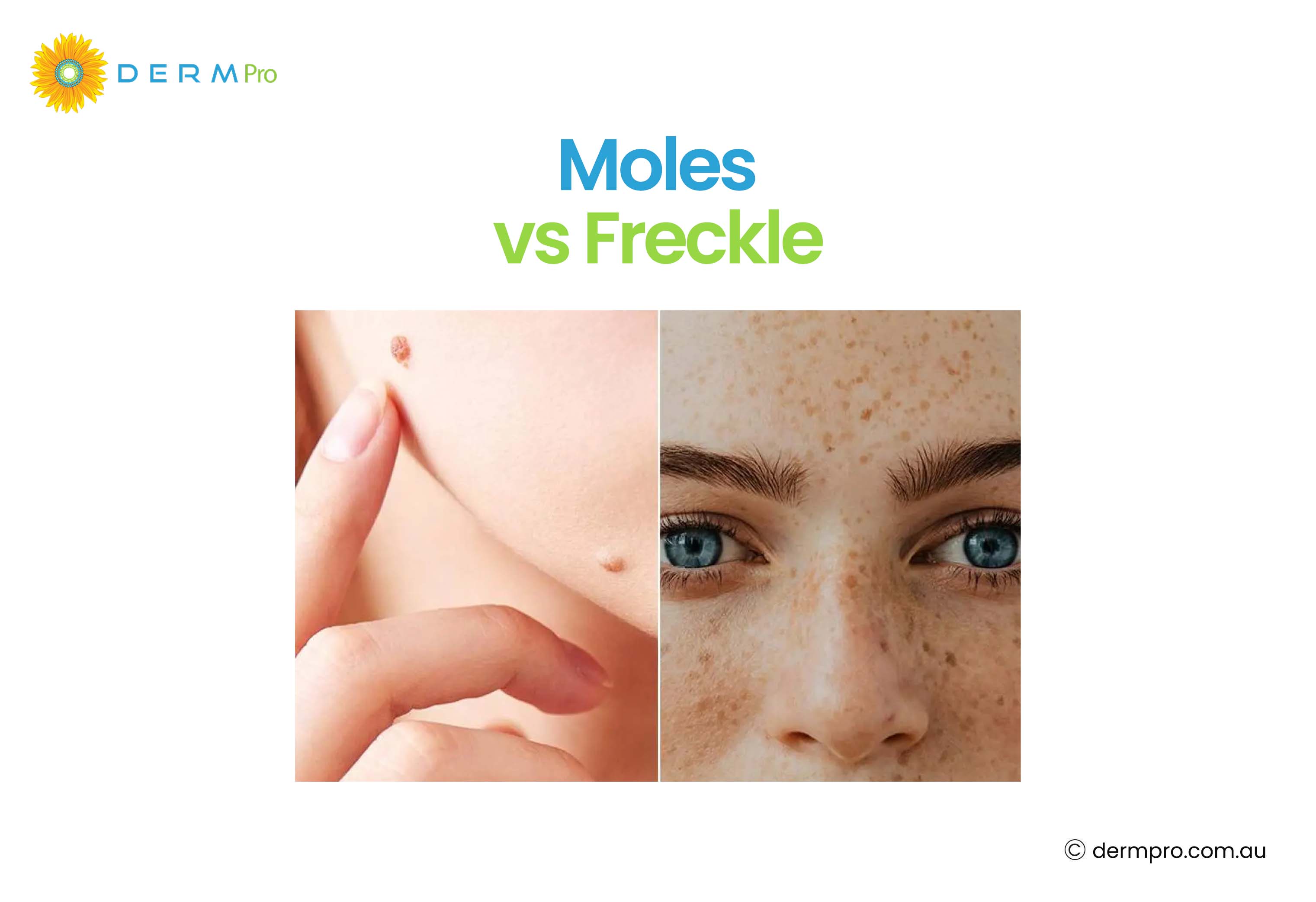 Moles vs Freckle