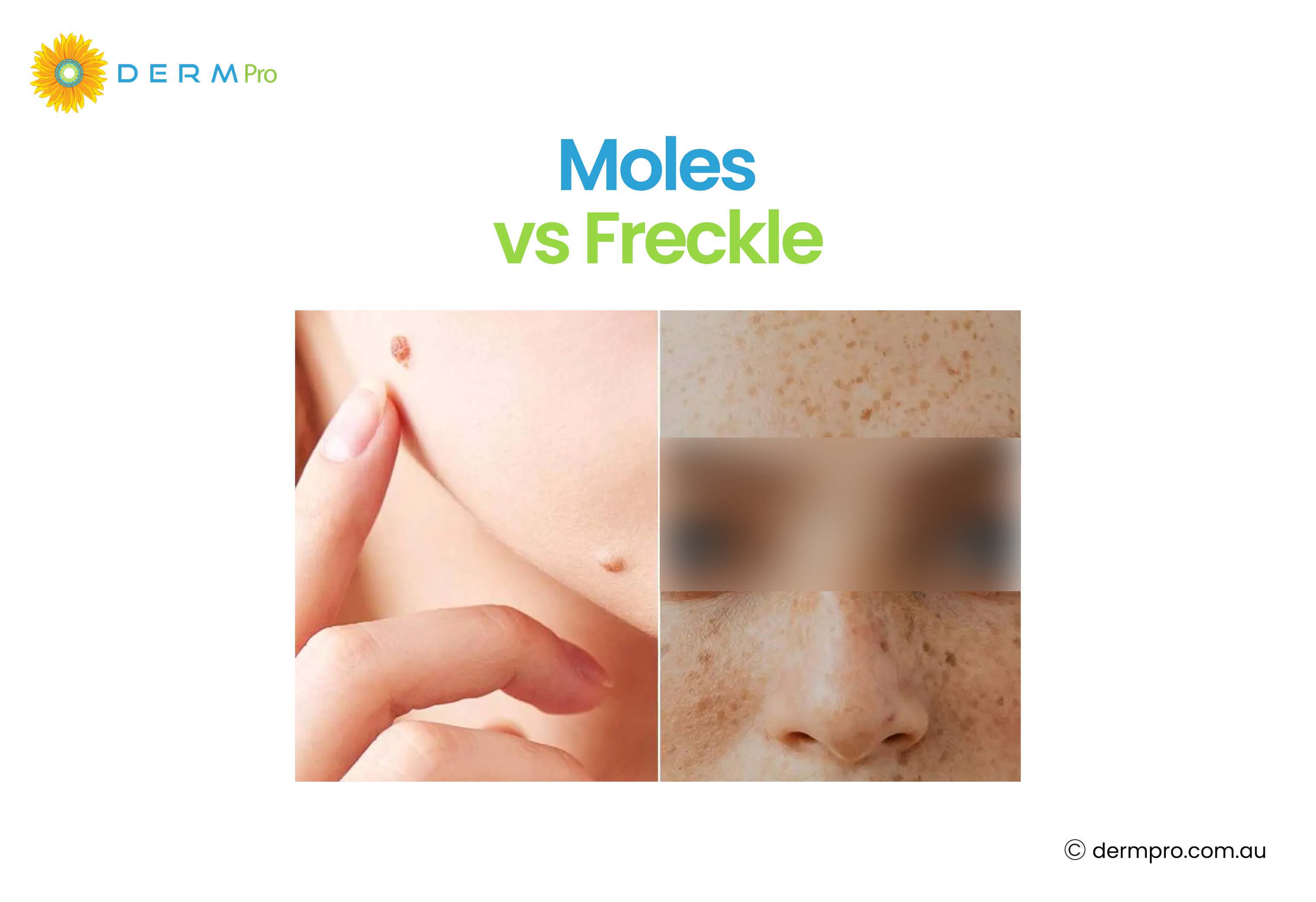 moles vs freckle 
