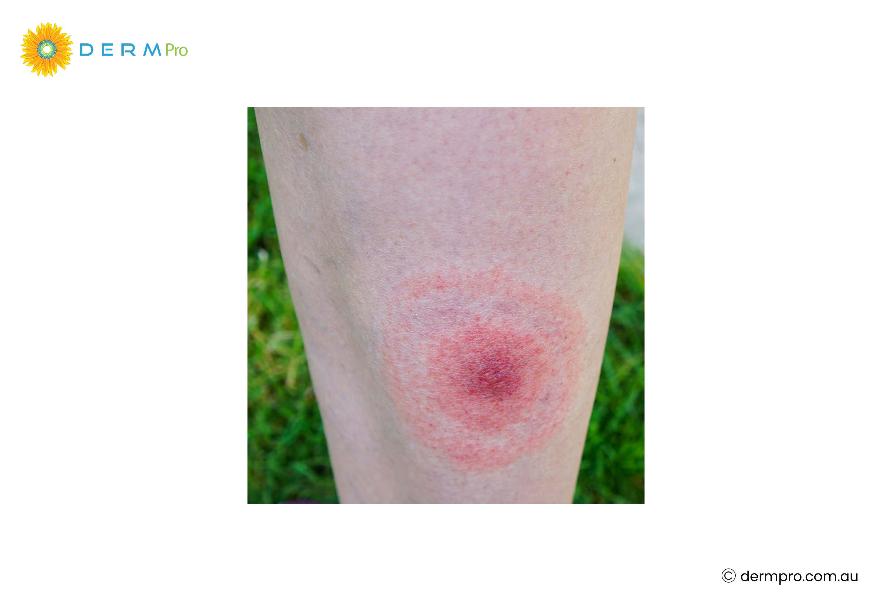 insect bites on skin irritation 