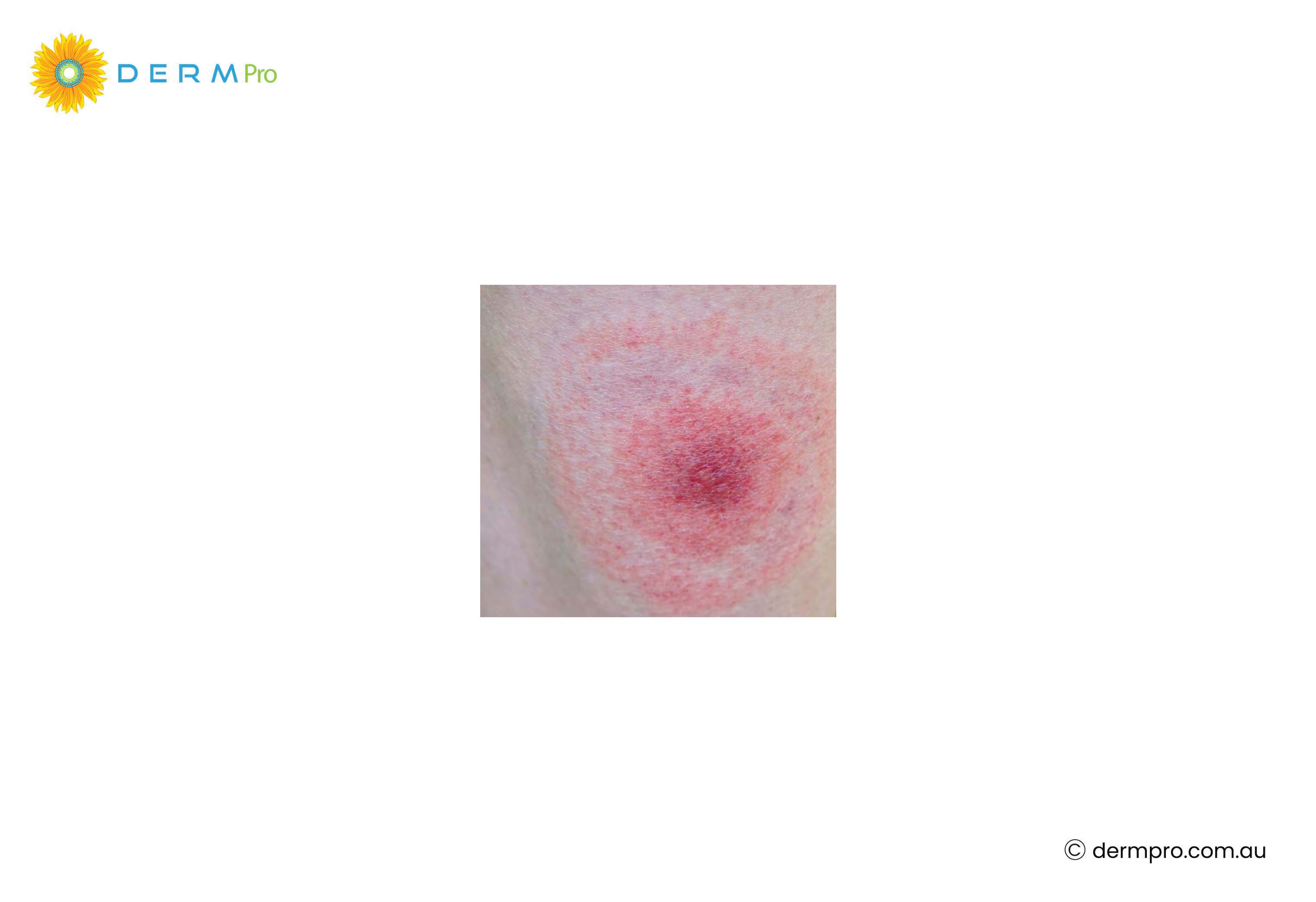 insect bites or skin irritation