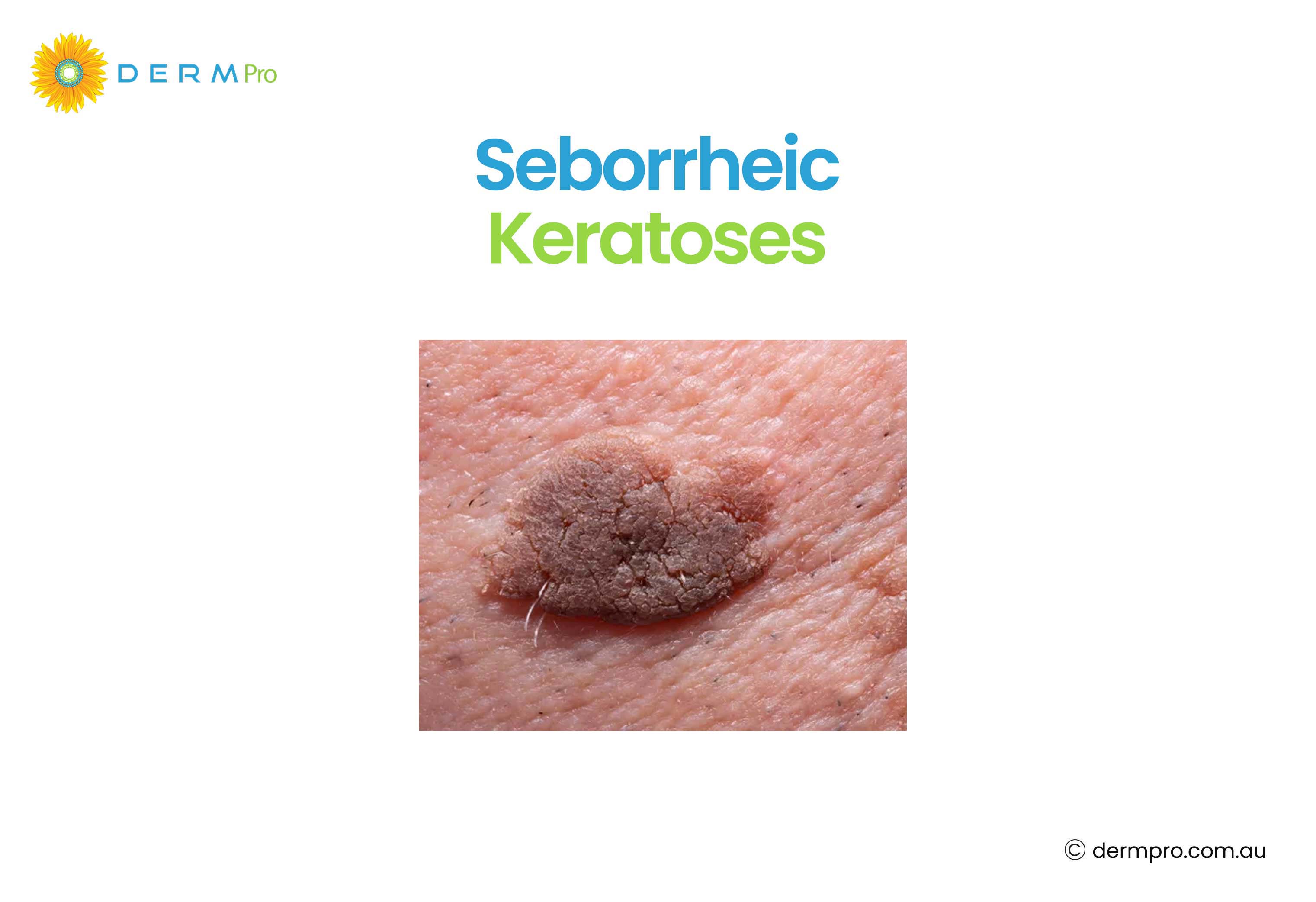 seborrheic keratosis