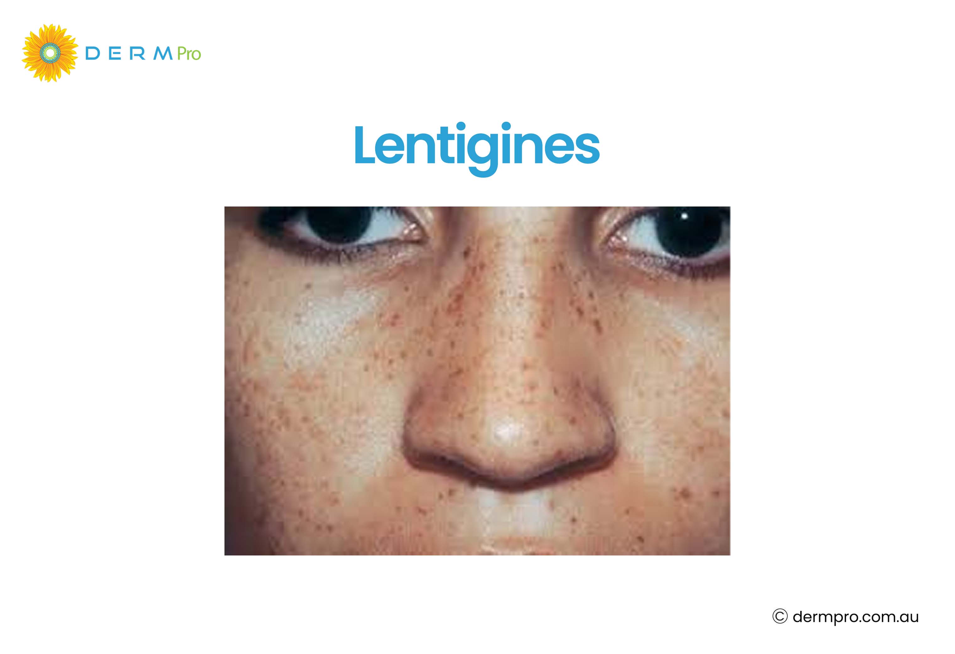 Lentigines