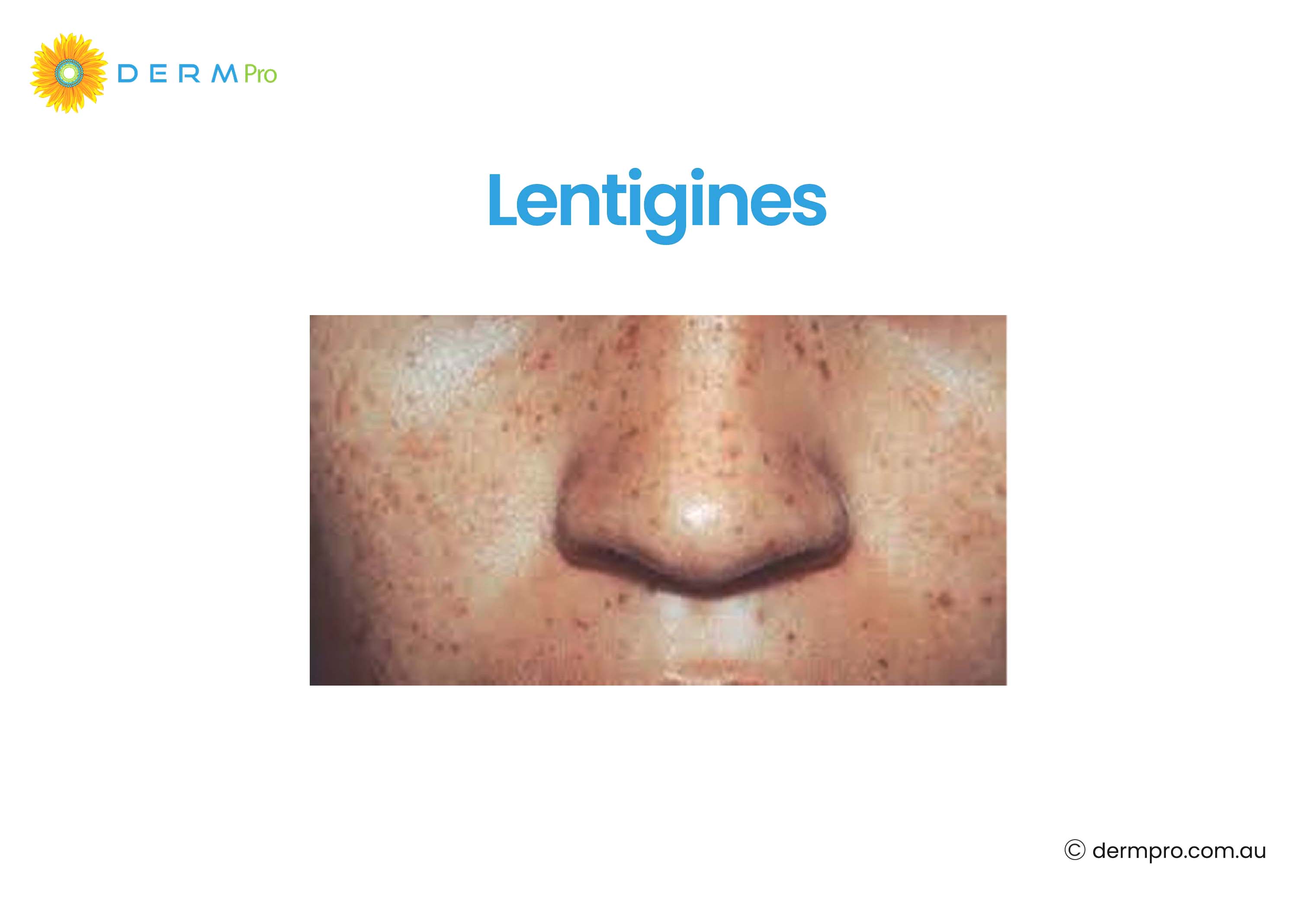 Lentigines 