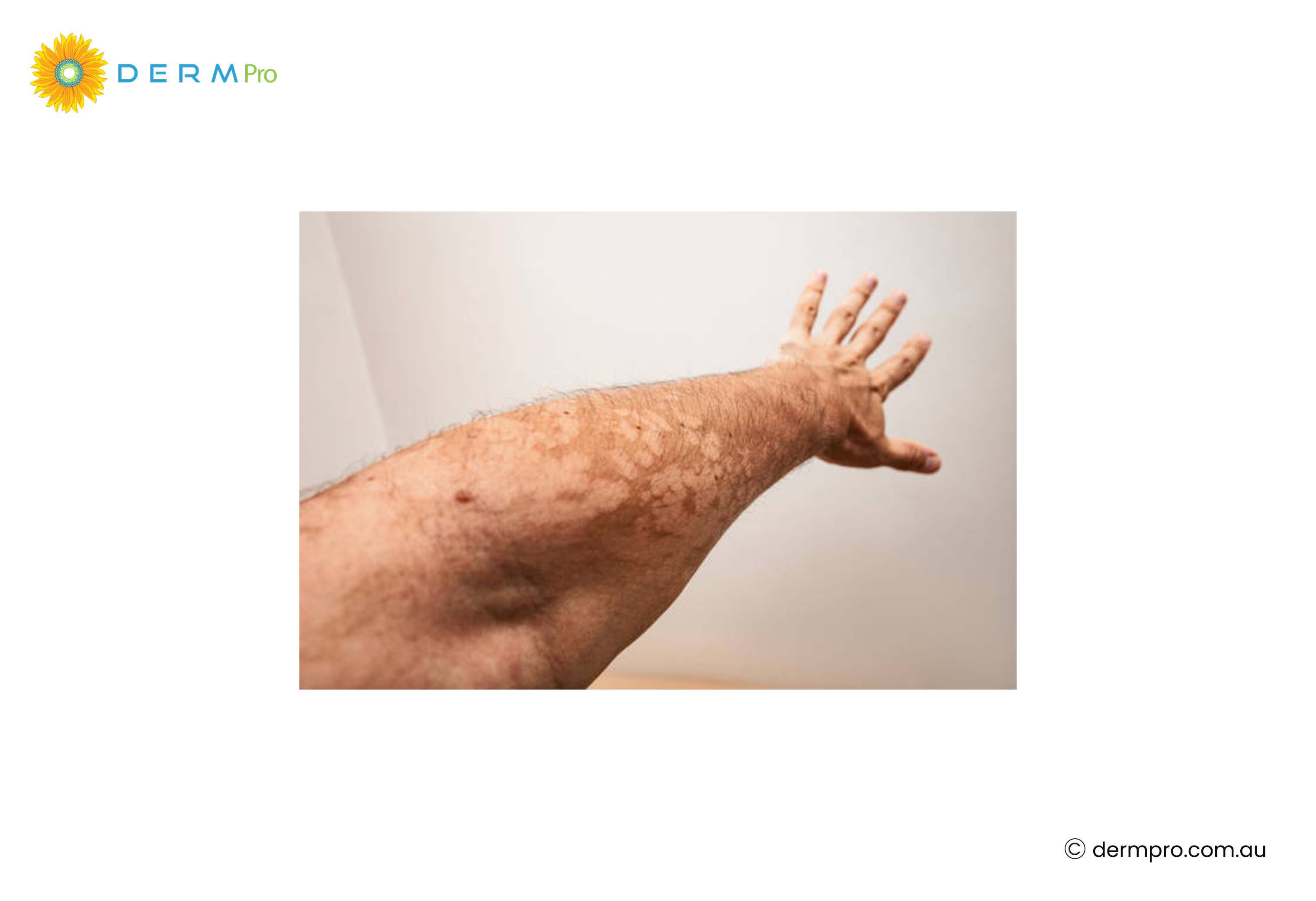 Tinea Versicolor