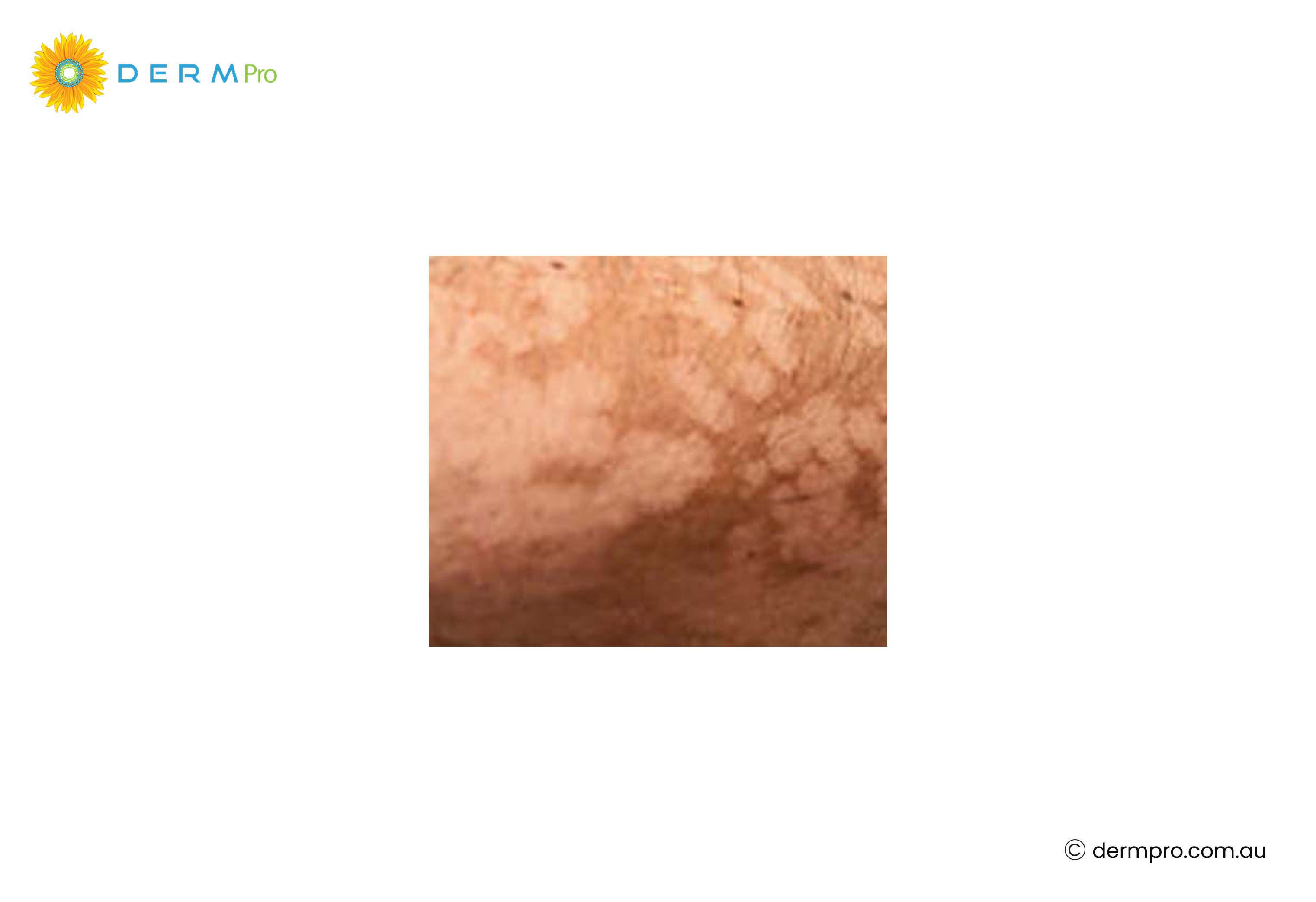 Tinea