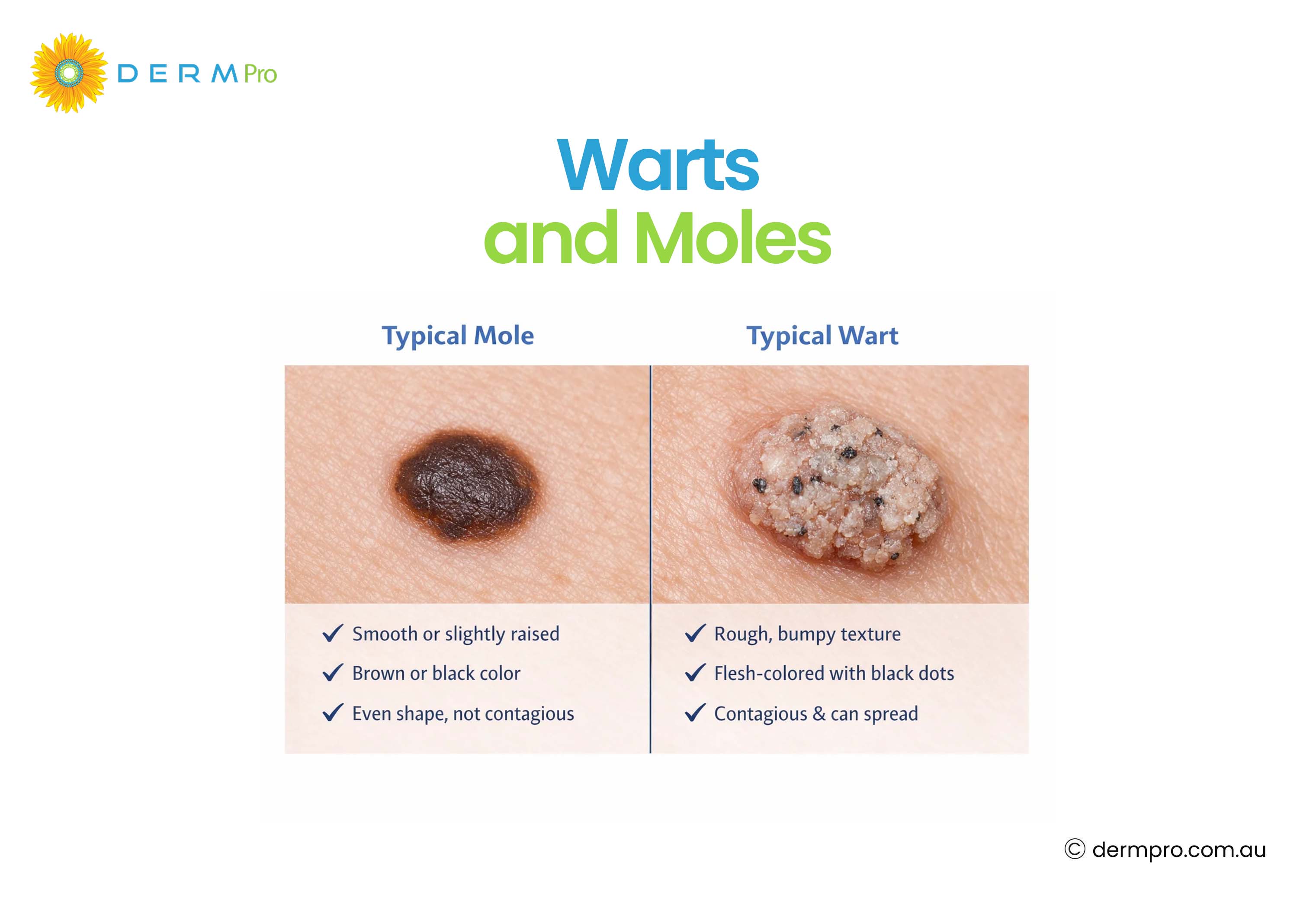 Warts and Moles