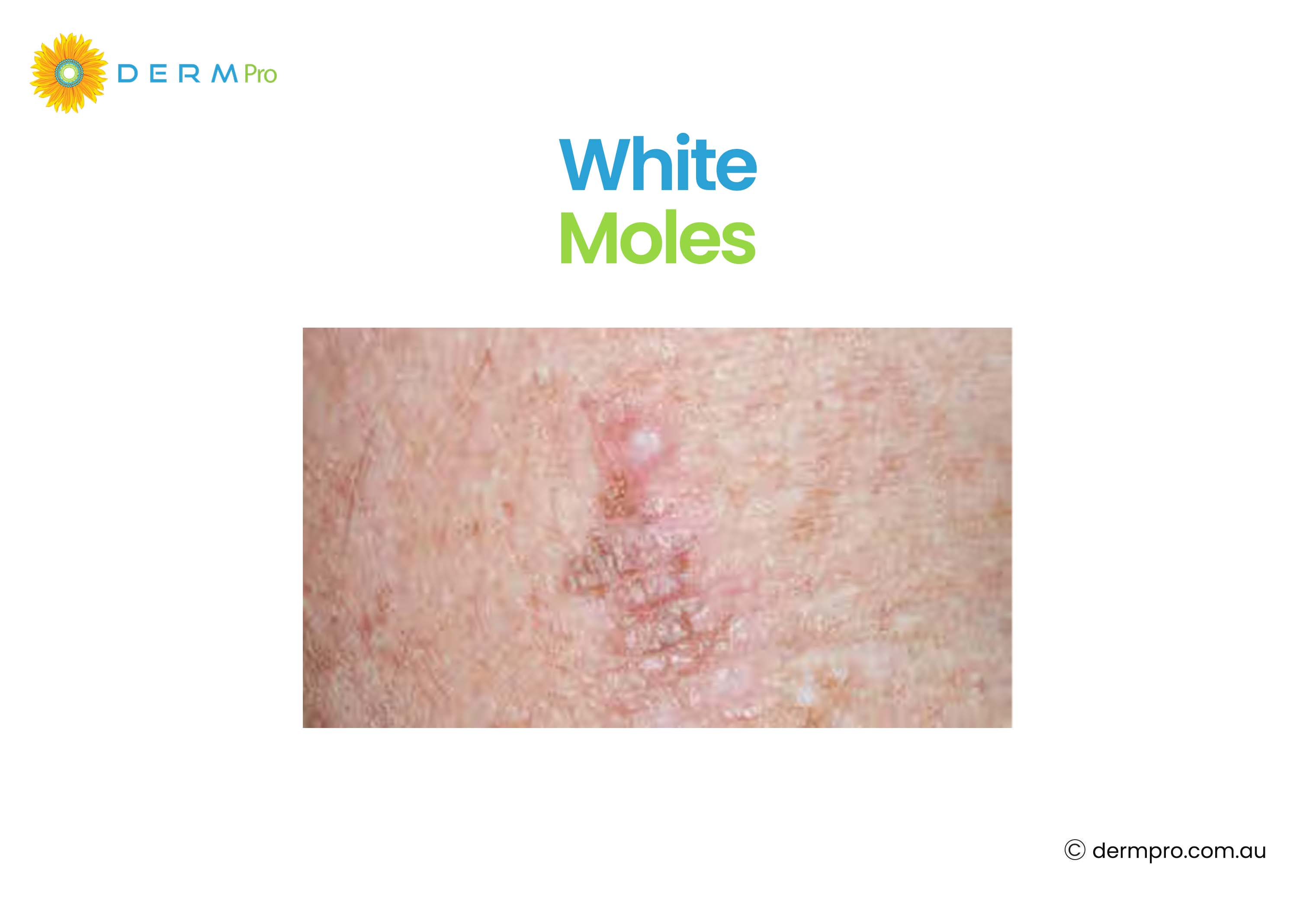 White Moles