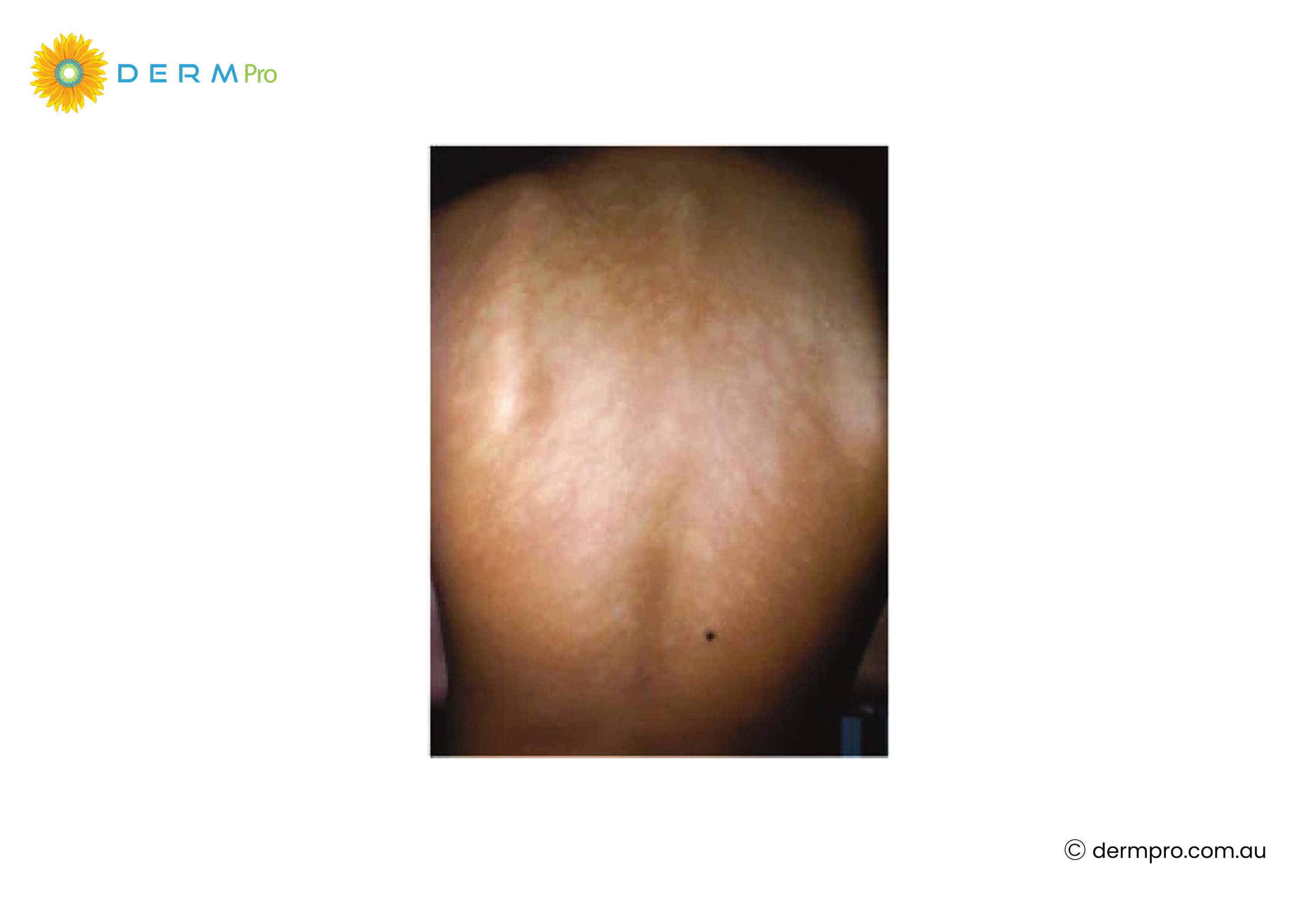 pityriasis alba 