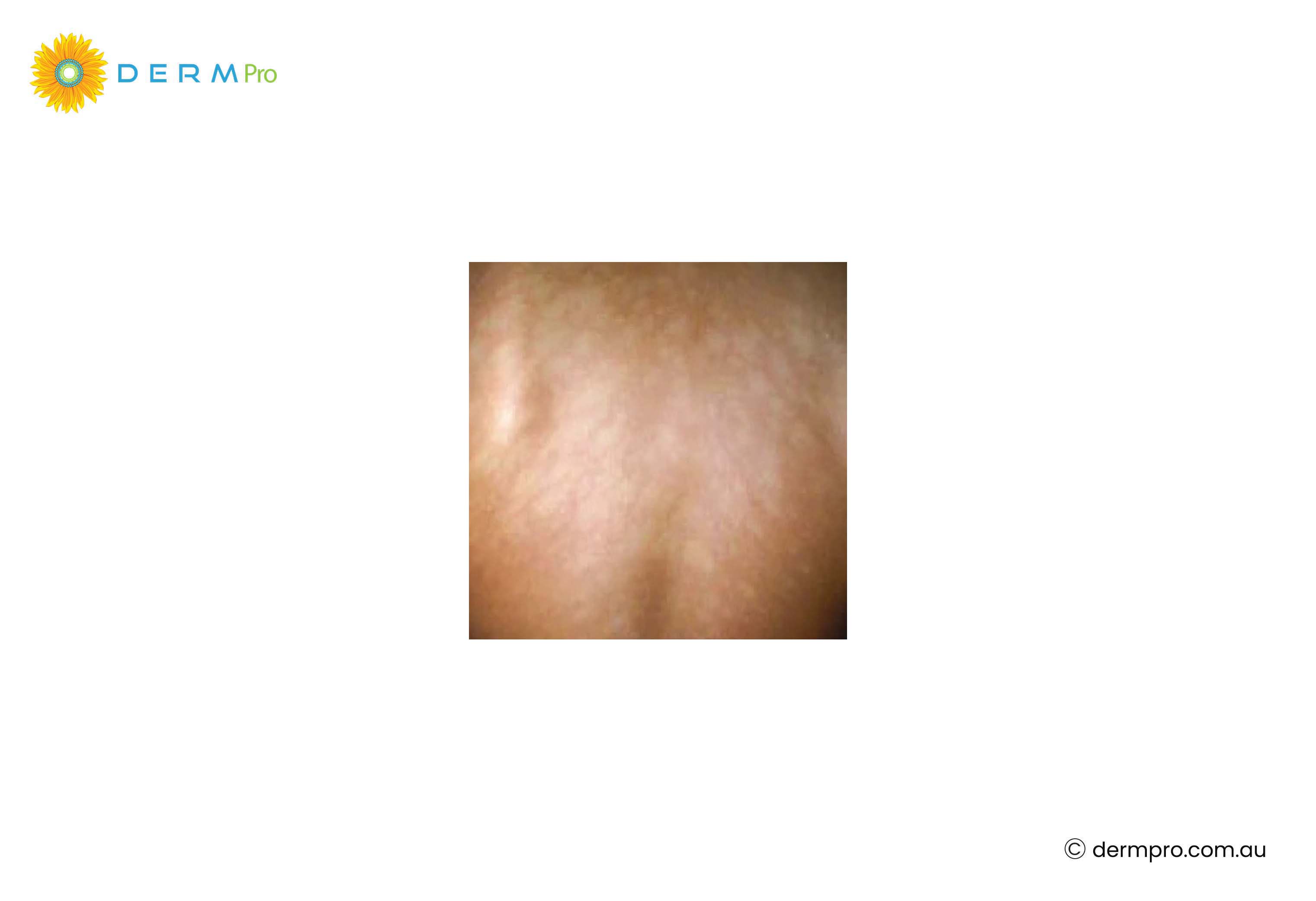 pityriasis alba
