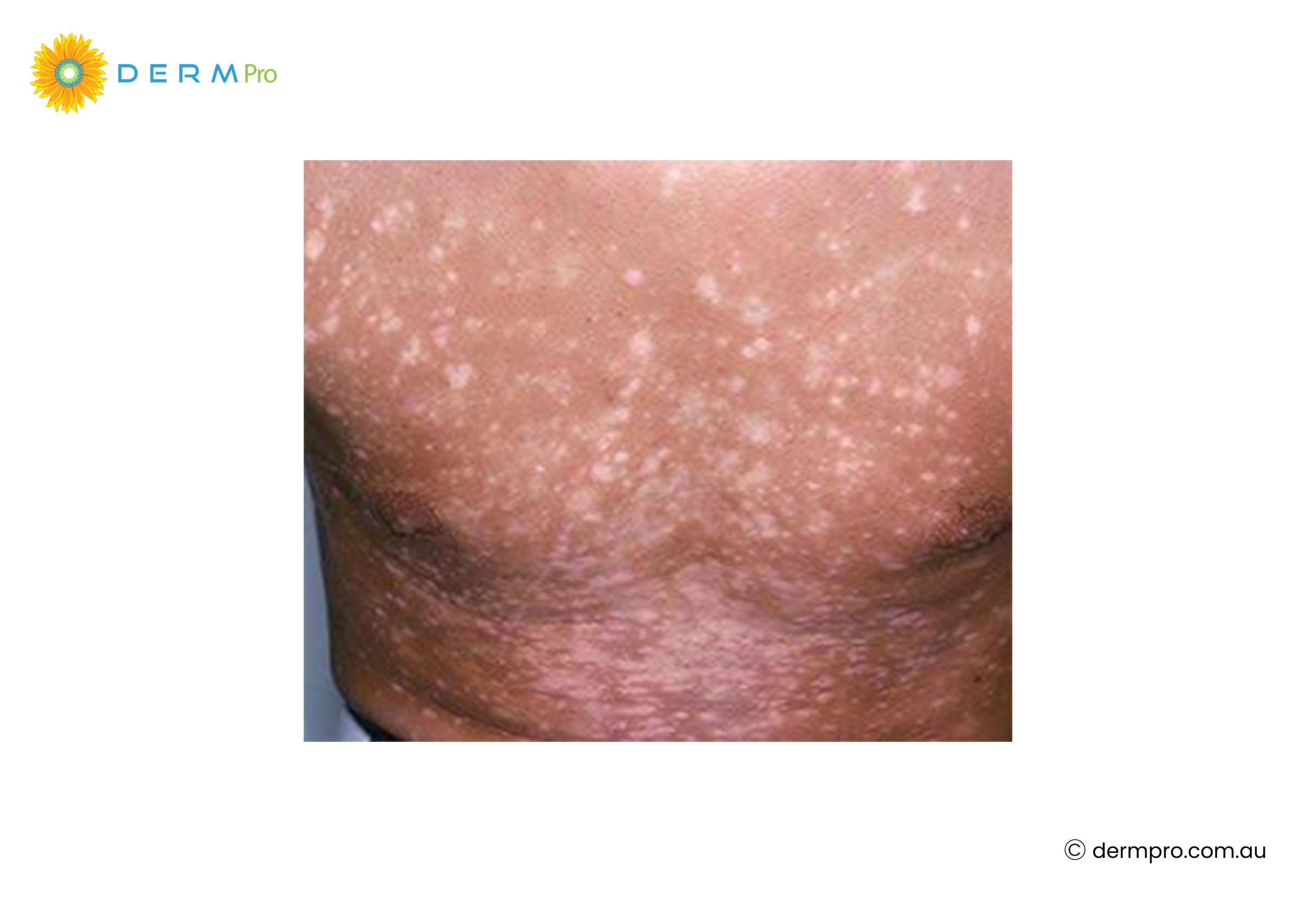 Post-Inflammatory Hypopigmentation